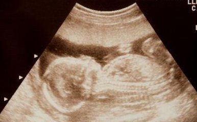 无锡第三代试管婴儿怀孕生孩子费用分享